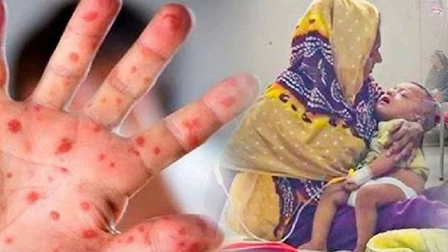 হামের উপসর্গে আরও ৪ শিশুর মৃত্যু